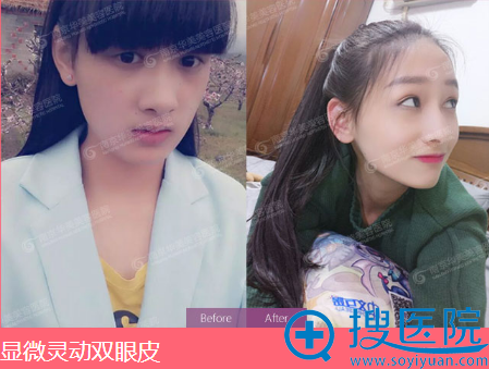 南京华美王小林显微灵动双眼皮案例 南京华美王小林显微灵动双眼皮案例