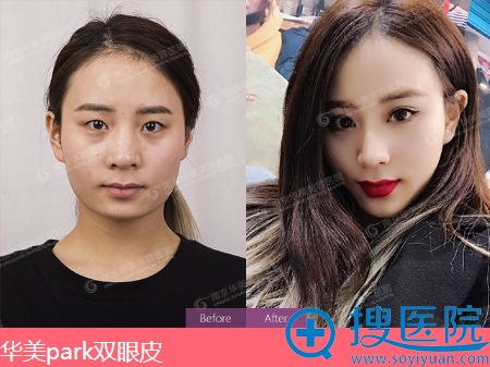 南京华美王小林PARK双眼皮案例 南京华美王小林PARK双眼皮案例