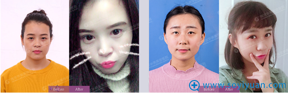 南京华美王小林双眼皮案例对比图 南京华美王小林双眼皮案例对比图