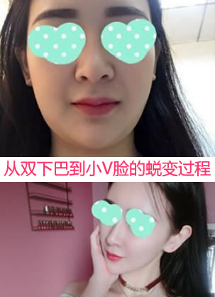 在金诺整形做完面部吸脂手术 秒变小v脸双下巴也没了