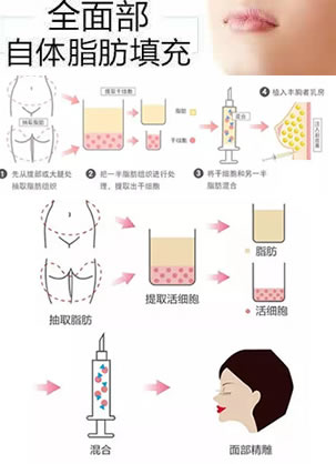 银山院长告诉你自体脂肪填充面部一般需要做几次 能保持多久?