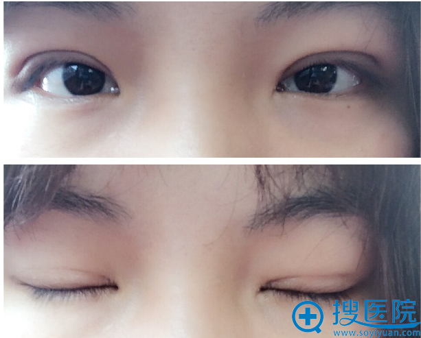 上海华安整形医院双眼皮13天恢复案例 上海华安整形医院双眼皮13天恢复案例
