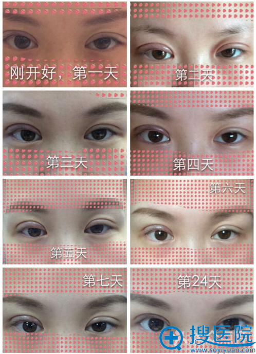 上海华安整形医院双眼皮术后恢复全过程图 上海华安整形医院双眼皮术后恢复全过程图