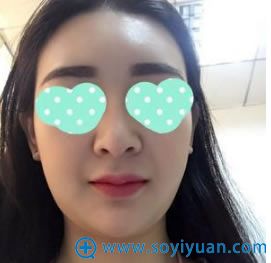 双下巴吸脂前的照片 双下巴吸脂前的照片