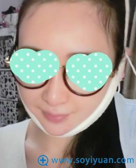 做双下巴吸脂手术即刻效果 做双下巴吸脂手术即刻效果