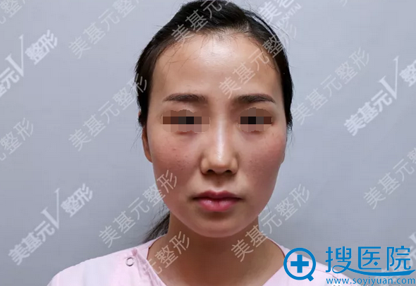 武汉哪里做脂肪填充好?美基元自体脂肪全面部填充案例告诉你