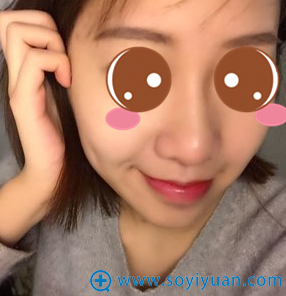 杭州整形医院骞洪鼻头缩小+鼻尖延长综合隆鼻案例恢复过程图
