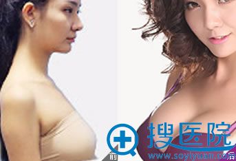宁波尚美整形医院假体隆胸案例 宁波尚美整形医院假体隆胸案例