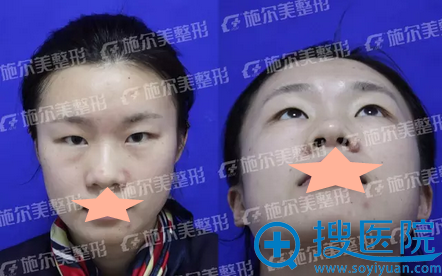 常州施尔美东方芭比综合美眼术+假体隆鼻术前 常州施尔美东方芭比综合美眼术+假体隆鼻术前
