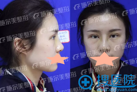 东方芭比综合美眼术+假体隆鼻术后10天恢复效果 东方芭比综合美眼术+假体隆鼻术后10天恢复效果