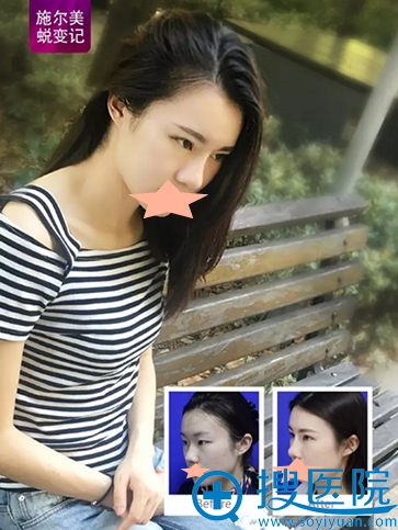 常州施尔美假体隆鼻术前术后效果对比图 常州施尔美假体隆鼻术前术后效果对比图