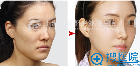 上海时光何晋龙颌面畸形矫正案例 上海时光何晋龙颌面畸形矫正案例