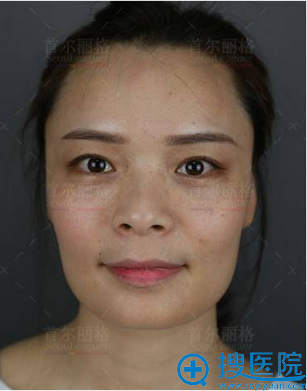 公开我找上海首尔丽格金柱医生做隆鼻和自体脂肪填充的亲身经历