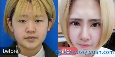 星艺整形双眼皮手术案例 星艺整形双眼皮手术案例