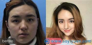 星艺整形眼部综合手术案例图 星艺整形眼部综合手术案例图