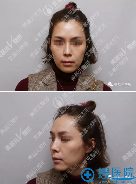 武汉线雕哪家做的好?美基元整形医院路世敏线雕提升案例告诉你