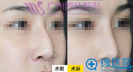 仿生理隆鼻前后对比照_广州博仕医疗美容医院 仿生理隆鼻前后对比照_广州博仕医疗美容医院