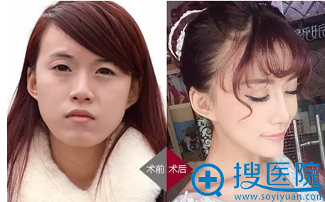 福州台江整形医院海鸥美鼻前后对比照 福州台江整形医院海鸥美鼻前后对比照