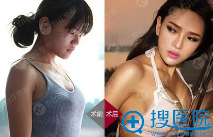 福州台江整形医院动感玉兔丰胸案例对比图 福州台江整形医院动感玉兔丰胸案例对比图