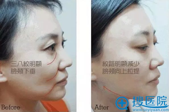 <!--<i data=20240710 data-id=11909></i>-->做面部线雕的案例图 <!--<i data=20240710 data-id=11909></i>-->做面部线雕的案例图