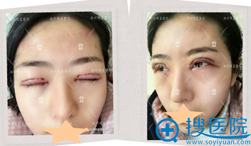 <!--<i data=20240710 data-id=9128></i>-->整形医院双眼皮修复术后睁眼闭眼效果 <!--<i data=20240710 data-id=9128></i>-->整形医院双眼皮修复术后睁眼闭眼效果