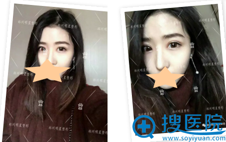 <!--<i data=20240710 data-id=9128></i>-->整形医院双眼皮术后1个月 <!--<i data=20240710 data-id=9128></i>-->整形医院双眼皮术后1个月