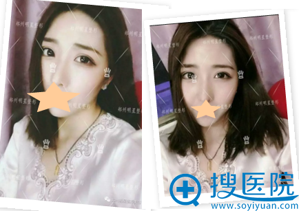 双眼皮修复术后3个月效果 双眼皮修复术后3个月效果