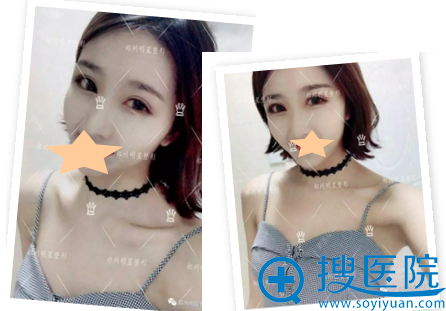 郑州<!--<i data=20240710 data-id=16639></i>-->双眼皮修复术后4个月照片 郑州<!--<i data=20240710 data-id=16639></i>-->双眼皮修复术后4个月照片