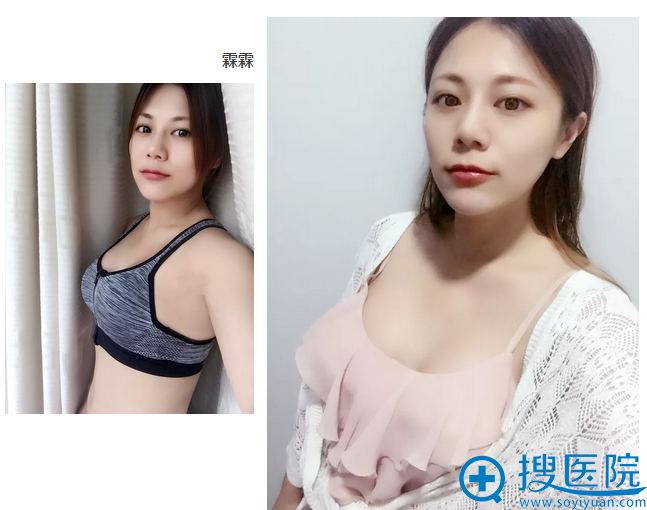 在伊莱美做完隆胸术后生活照 在伊莱美做完隆胸术后生活照