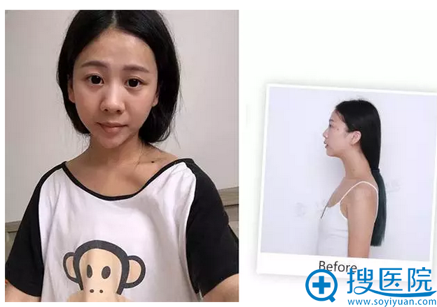 隆胸术前照片 隆胸术前照片