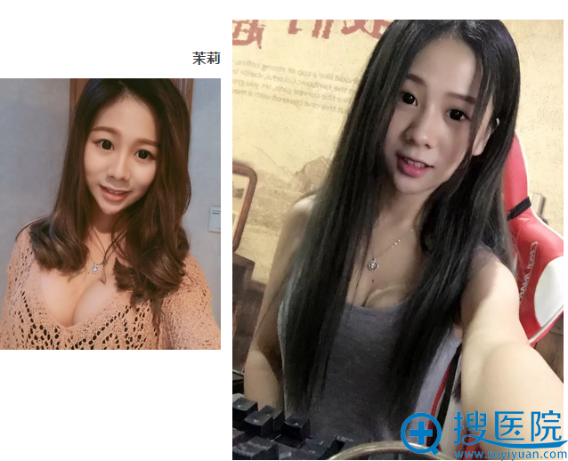 在上海伊莱美做完内窥镜隆胸术后自拍 在上海伊莱美做完内窥镜隆胸术后自拍
