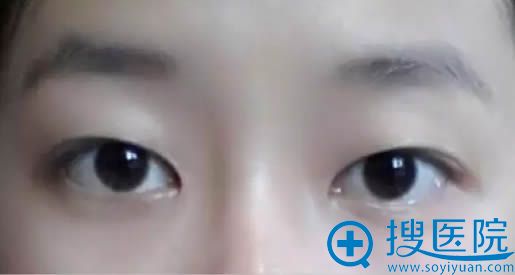 在<!--<i data=20240710 data-id=11757></i>-->美容医院做眼整形术前照 在<!--<i data=20240710 data-id=11757></i>-->美容医院做眼整形术前照