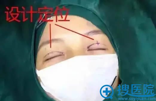 双眼皮手术前的设计方案 双眼皮手术前的设计方案