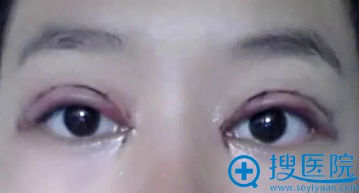 切开双眼皮术后即刻的照片 切开双眼皮术后即刻的照片