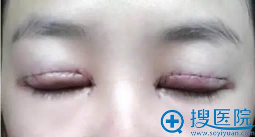 拆完纱布后第三天已经消肿多了 拆完纱布后第三天已经消肿多了