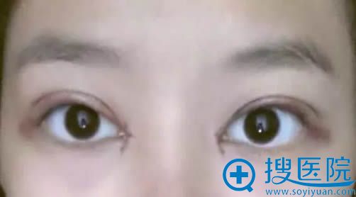 <!--<i data=20240710 data-id=11757></i>--><!--<i data=20240710 data-id=16291></i>-->双眼皮术后第6天恢复效果 <!--<i data=20240710 data-id=11757></i>--><!--<i data=20240710 data-id=16291></i>-->双眼皮术后第6天恢复效果