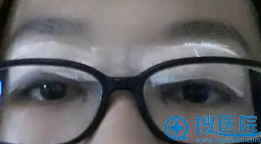 全切双眼皮术后天眼睛包着纱布的样子 全切双眼皮术后天眼睛包着纱布的样子