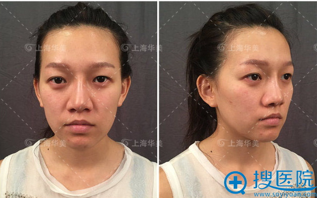 【实例】看我找上海华美张朋主任做的双眼皮案例效果怎么样