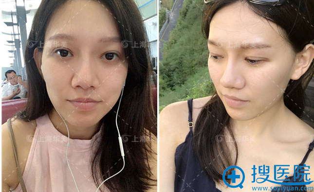 割完双眼皮术后4周的我长这样 割完双眼皮术后4周的我长这样