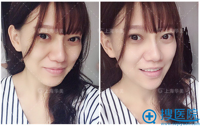 上海华美张朋主任双眼皮术后两个月自拍 上海华美张朋主任双眼皮术后两个月自拍