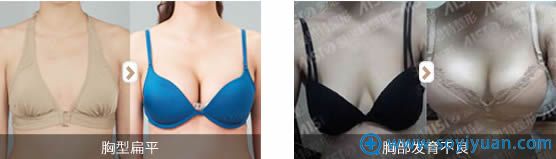 胡朝辉隆胸前后对比效果 胡朝辉隆胸前后对比效果
