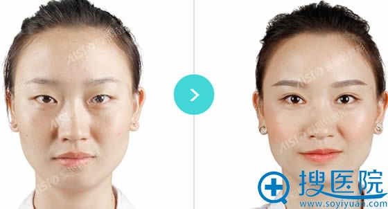 长沙爱思特张姣姣双眼皮案例图 长沙爱思特张姣姣双眼皮案例图