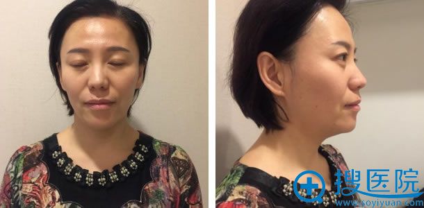 吴女士做自体脂肪填充前的照片 吴女士做自体脂肪填充前的照片