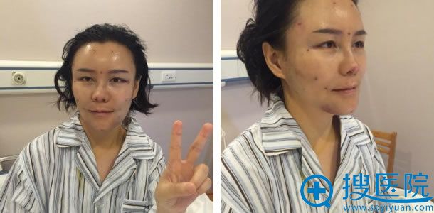 吴女士做完脂肪填充的正侧面照片 吴女士做完脂肪填充的正侧面照片