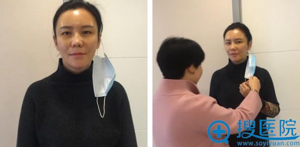 吴女士做脂肪填充面部11天效果 吴女士做脂肪填充面部11天效果