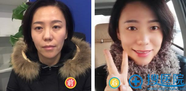 吴女士做脂肪填充前后效果对比 吴女士做脂肪填充前后效果对比