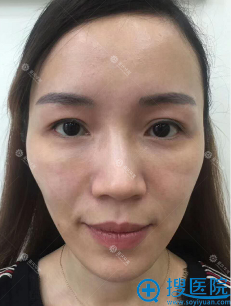 【视频案例】看我找重庆华美潘宝华做的面部线雕提升效果好不好