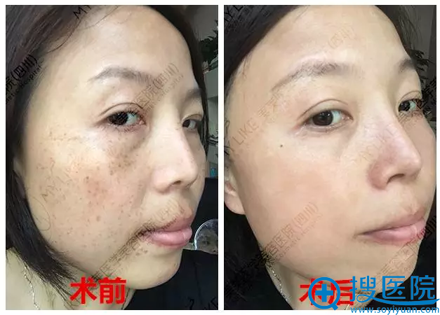 �ɶ�������Ƥ�����ϸ�ڷŴ�ͼ�Ա�