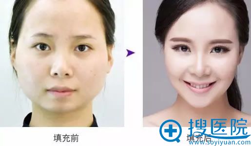 邵宏教授注射玻尿酸填充的案例 邵宏教授注射玻尿酸填充的案例