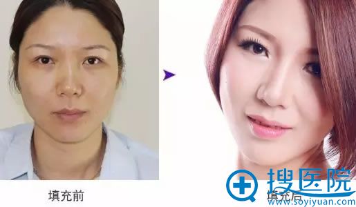 微整形医生邵宏的玻尿酸隆鼻案例 微整形医生邵宏的玻尿酸隆鼻案例